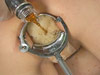 Extreme speculum stretched gaping anus with cola enema